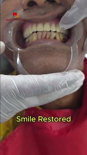 Complete Denture Transformation 🦷 | Unbelievable Results! #dentalcare #shortsfeed #reel #teeth