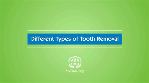 Different Types of Tooth Removal