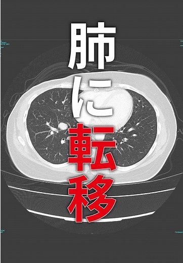 乳がん再発と生きる力 - ステージ4の挑戦