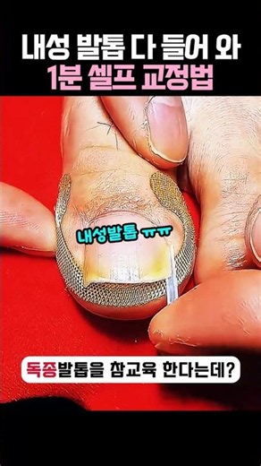 내성발톱 1분만에 교정법