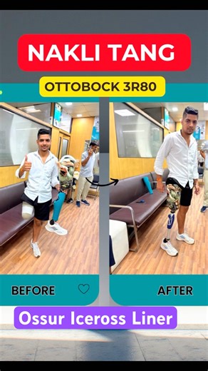 🤯Ottobock 3R80 | Ossur Liner | Carbon Foot Ossur | Proflex XC | #ottobock #ossur #naklitang #3r80