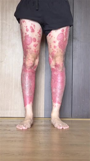 Understanding Hyperpigmentation After Psoriasis Healing