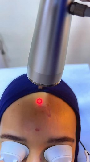 80 reactions · 5 comments | Traitement des cicatrices au laser CO2 @drzamouchedermatocheraga #laser #laserco2 #drzamouche #drzamouchedermatocheraga | Dermatologue Cheraga - Dr. ZAMOUCHE | Facebook