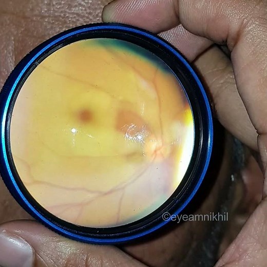 Central retinal artery occlusion (CRAO) as seen on indirect ophthalmoscopy