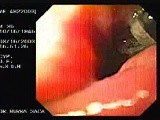 Flexible Endoscopic Suturing - Preparing the Sutures • Video • MEDtube.net