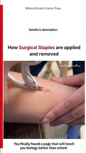 📎 How Surgical Staples are 🩹 applied and removed 🧑‍⚕️| MDCT