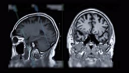 MRI of the brain compare sagittal plane and coronal for diagnostic...