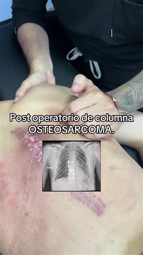 Terapia manual como abordaje inicial en Dx Osteosarcoma. #fisio #rehab #osteosarcoma #cancer #postoperatorio