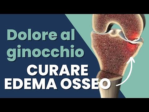 How to treat bone edema in the knee - A special cause of knee pain