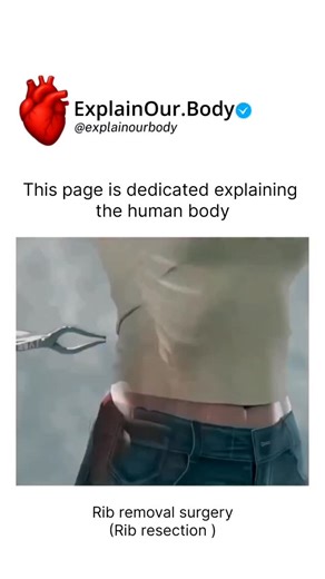 HEALTH | MEDICAL | LIFE on Instagram: "Rib resection is a surgical procedure where a portion of a rib or an entire rib is removed. While often used to treat medical issues like bone tumors or to relieve pressure in Thoracic Outlet Syndrome, it is also discussed in the context of waist-narrowing procedures. This animation shows the precise anatomical steps involved in removing the lower ribs and how it changes the body's structure. . . .​#ribremoval #surgery #medicalanimation #humanbody #anatomy"