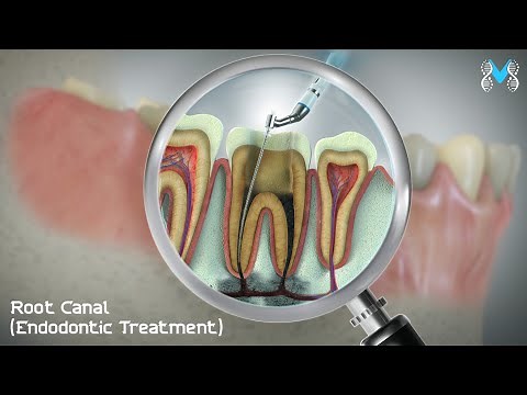 Root Canal (Endodontic Treatment)