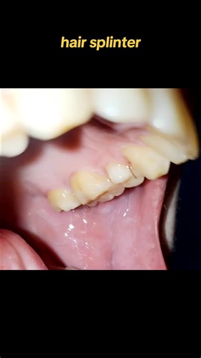 Hair Splinter Stuck in Gum: Crazy Removal Process