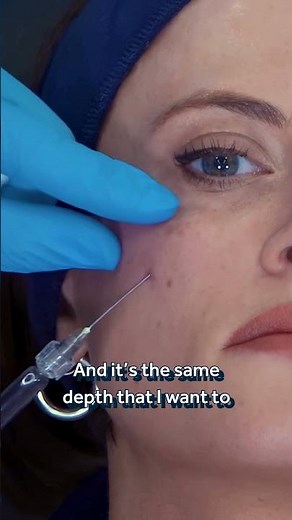 GEM Tear Trough Filler Demonstration: Injecting Under the SubOrbicularis Oculi with Dr Tristan Mehta