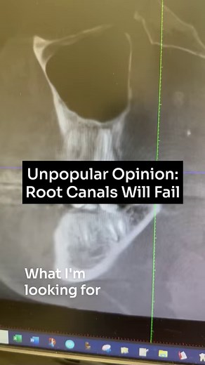 Unpopular Opinion: Root Canals Will Fail. While root canals are a common and often successful (short term) treatment for infected teeth, they will fail over time. One of the main reasons for root canal failure is bacteria that build up around the end of the root, eating away the bone and creating a new infection. What do I recommend instead? Preventing root canals first. And if preventing them is not an option then I recommend a ceramic implant. #rootcanals #unpopularopinion #ceramicimplant #alt