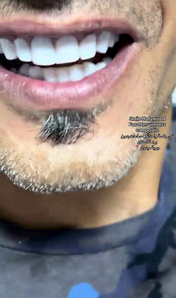 Bienvenue à cabinet dr.elhedi [smile_one] ✨🦷 Notre équipe vous accueille avec professionnalisme et bienveillance, dans un cadre moderne et convivial, afin de prendre soin de votre sourire et de votre santé bucco-dentaire. Votre confiance est notre priorité, et votre confort notre engagement. Nous serons ravis de vous accueillir très bientôt ! Pour Prendre un rendez-vous appellè 50070856 ou par msj prv et bienvenue 🇹🇳❤️