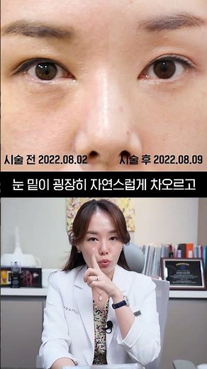 눈밑 꺼짐 + 다크서클 + 주름? 울트라콜200으로 한방에싹~!