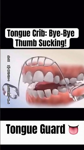 Tongue Crib: Bye-Bye Thumb Sucking!