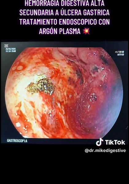 Tratamiento Endoscópico de Hemorragia Digestiva Alta