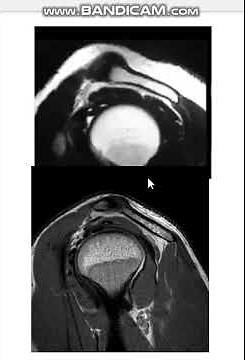 #Type 1 acromion shape