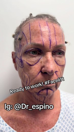 Transform Your Look with Deep Plane Facelift in Tijuana