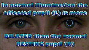 17K views · 373 reactions | Adie's tonic pupil. #OphthalmologyPearls | Ophthalmology Pearls | Facebook