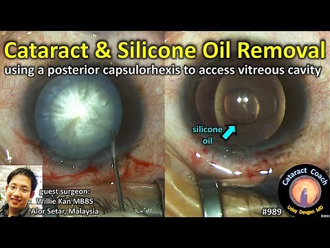 Cataract Surgery and Simultaneous Silicone Oil Removal