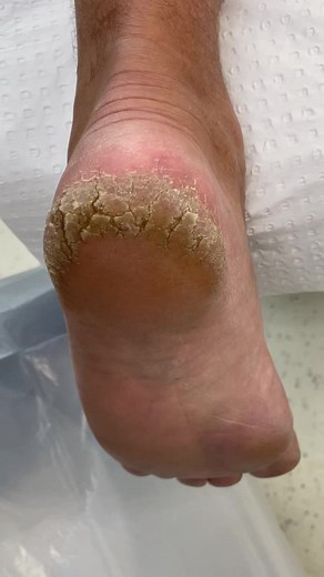 Cutaneous Horn Removal - Satisfying Feet Braga Procedure