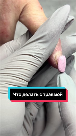 Уход за ногтями при травме: пошаговое руководство