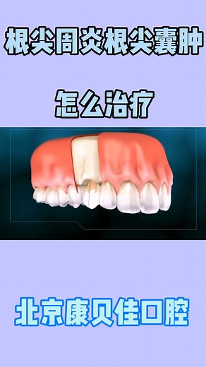 根尖周炎，根尖囊肿，怎么治疗，一起来看具