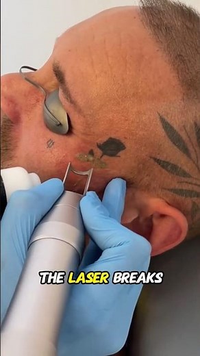 How to Remove Tattoos from Our Body?