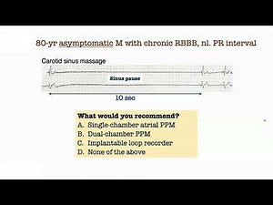 ECG Case 7 - What would you recommend for this PAUSE #ecg #heart #cardiology