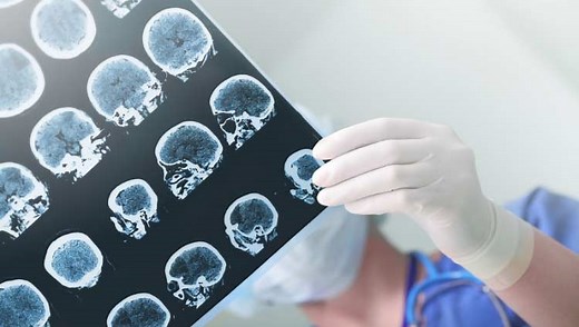 AVC (derrame cerebral): sintomas, causas e tratamento
