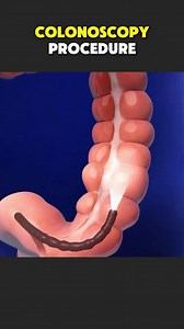 911K views · 2.6K reactions | colonoscopy procedure. Medical 3d animations. #colonoscopy #medicaleducation #healtheducation #healthcaretips | Surgery Page | Facebook