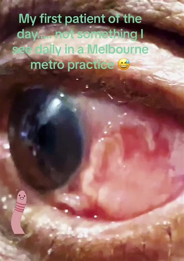 Eye Worms: Understanding and Treating Parasites in the Eye