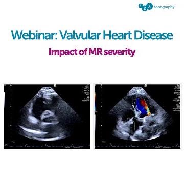 Watch this extract from our webinar on aortic valve disease! 🧐 👀
