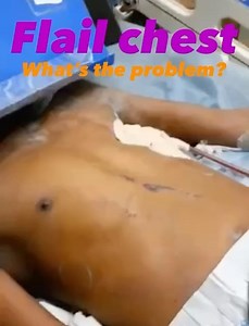 The Prehospitalist | FLAIL CHEST: “Three or more ribs broken in two or more places.” But what’s the problem? When we breathe normally, we breathe via negative... | Instagram
