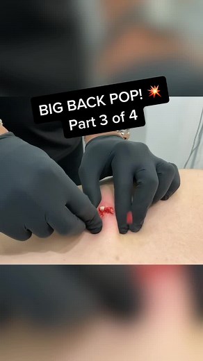 Big back pop, part 3 of 4!💥 #cyst #pimple #pimplepopper #pimplepopping #drmudgil