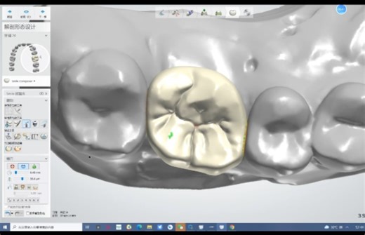 3shape种植单冠设计，简单又详细的设计流程，欢迎大家指教