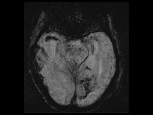 Acute MCA Infarct