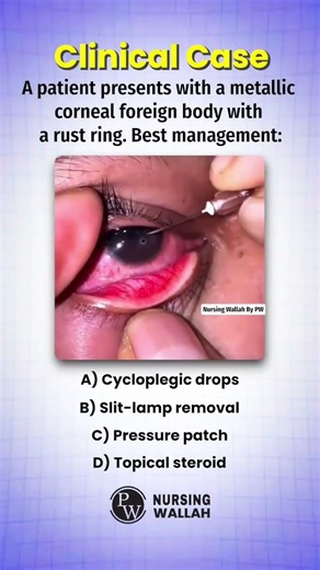 Corneal Rust Ring Case – Do You Know the Correct Step? #shorts #trendingshorts #nursingmcqs #norcet