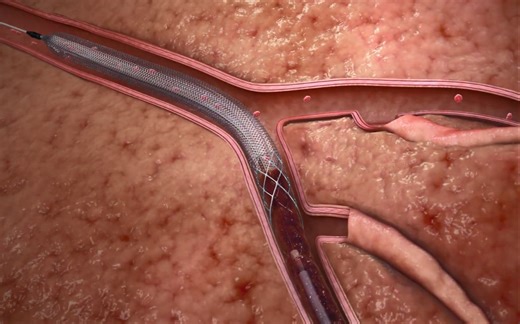 ClotTriever静脉取栓装置- Inari Medical