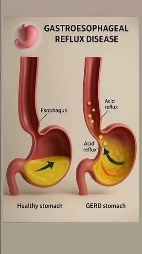 Gastroesophageal Reflux Disease