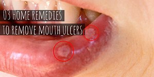 31 Home Remedies to get rid of Mouth Ulcers (Mouth Sores) - Superloudmouth