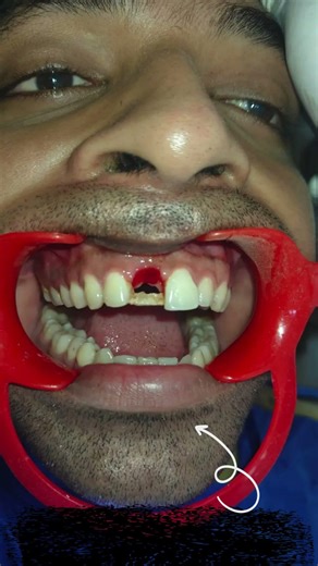 🦷 Permanent Solution for Missing Teeth – Dental Implants