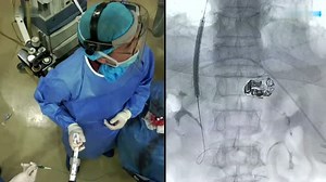 TIPS（经颈静脉肝内门体分流术）手术视频_高清1080P在线观看平台_腾讯视频