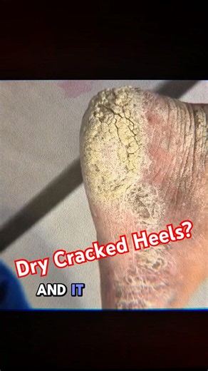 Why do I have dry cracked heels in the summer time?