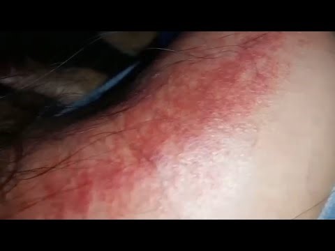 Kerokan Masuk Angin Sampai Gosong