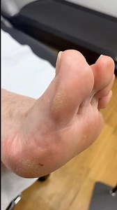 17K views · 63 reactions | Experience the satisfaction of big toe callus removal! #PodiatryMagic #FootCareRevealed . . #footpain #plantarfasciitis #heelpain #podiatry #footcare #podiatrist #orthotics #feet #foothealth #kneepain #foot #running #anklepain #backpain #bunions #flatfeet #healthyfeet #footpainrelief #arthritis #health #footdoctor #bunion #fyp #foryou #viralreels #explore | Docpods Treatment | Facebook
