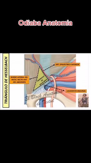 Triángulo de Hesselbach y Hernias Inguinales: Anatomía y Diagnóstico