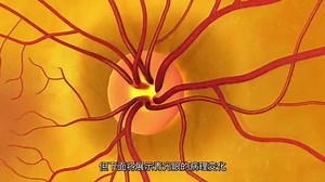 医学动画：眼底检查（Fundus Examination）眼底检查是利用检眼镜等设备，深入观察视网膜、视神经、玻璃体及血管健康的关键眼科检查。高危人群（必须定期检查）：1、高度近视（>600度）视网膜较薄，患视网膜脱离、变性风险高，应每年至少进行一次散瞳检查；2、高血压/糖尿病患者血管病变直接反映在眼底，即“机体的橱窗”；3、中老年人及家族史者 预防年龄相关性黄斑变性、青光眼。